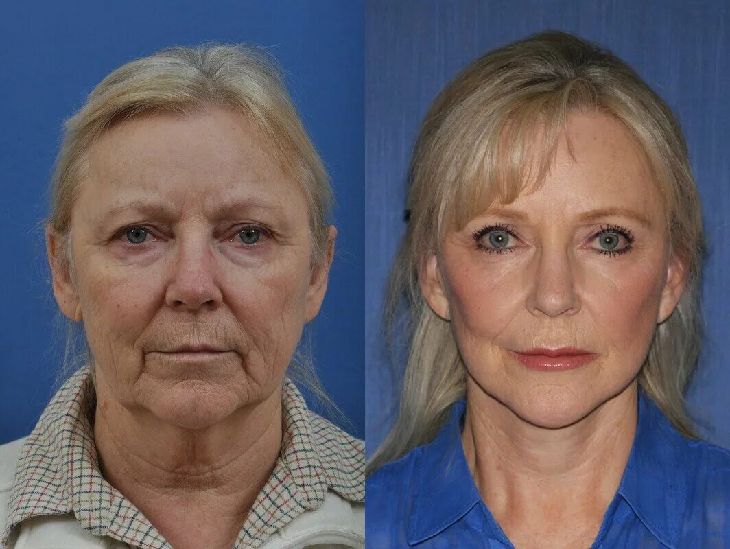 Круговая пластика лица. Лифтинг нефертити ботоксом. Круговая пластика лица. Как делается подтяжка лица. Круговая подтяжка лица в 60 лет.
