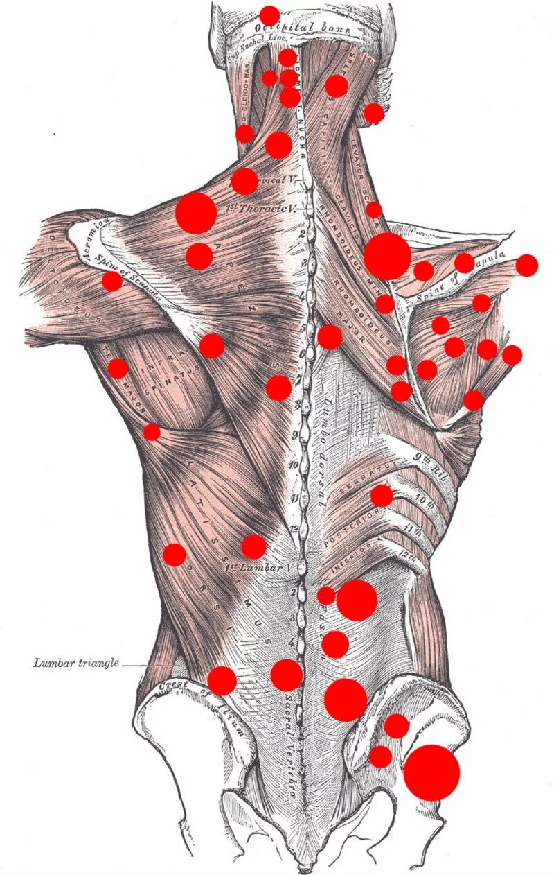 Точки на пояснице. Миофасциальные триггерные точки. Миофасциальный болевой синдром триггерные точки. Триггерные точки в мышцах спины.