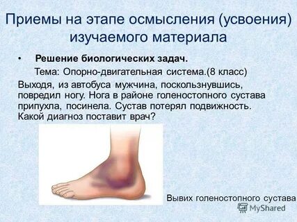 Растяжение голеностопа степени