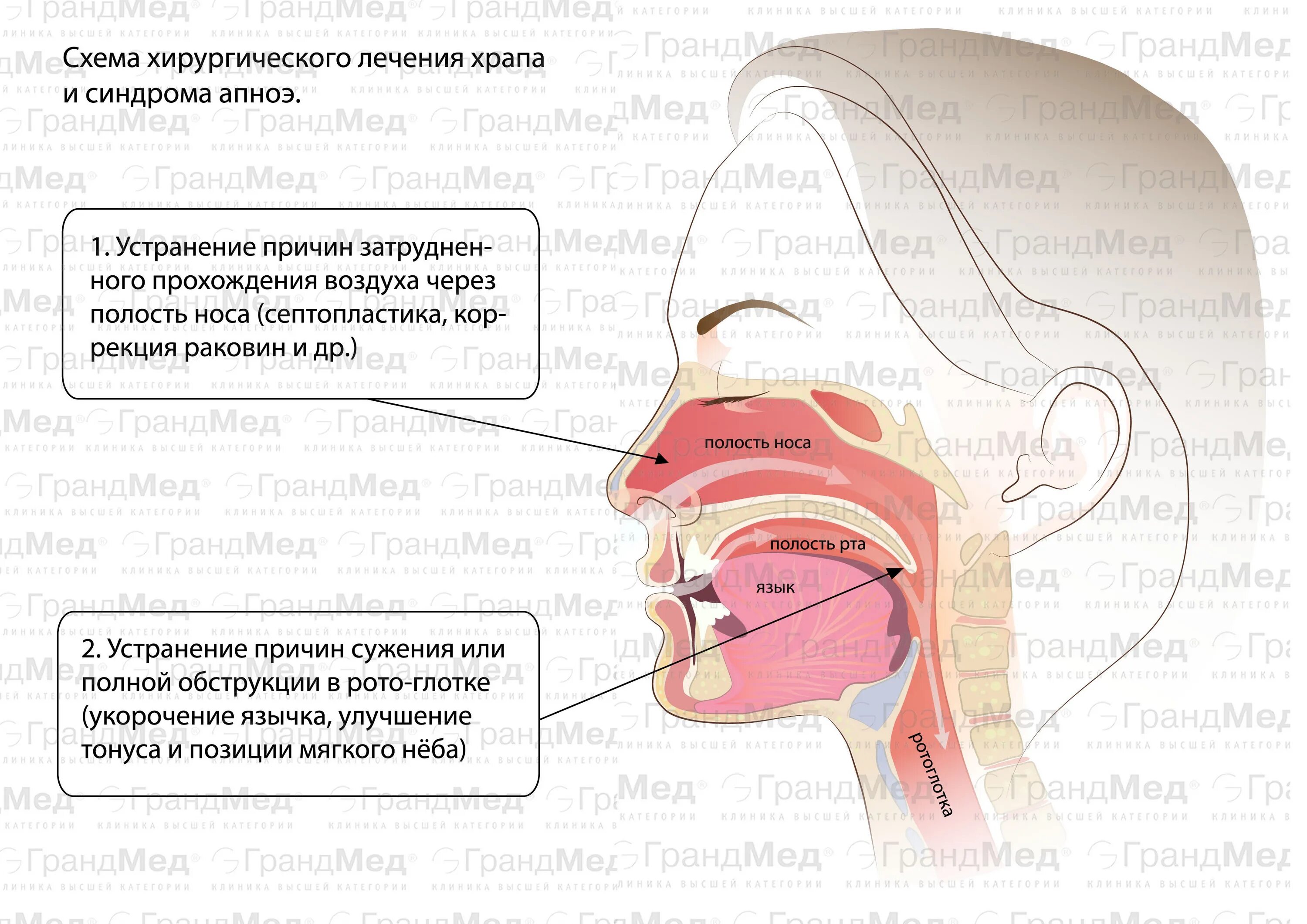 Почему появляется храп. Лечение храпа. Храп механизм возникновения.