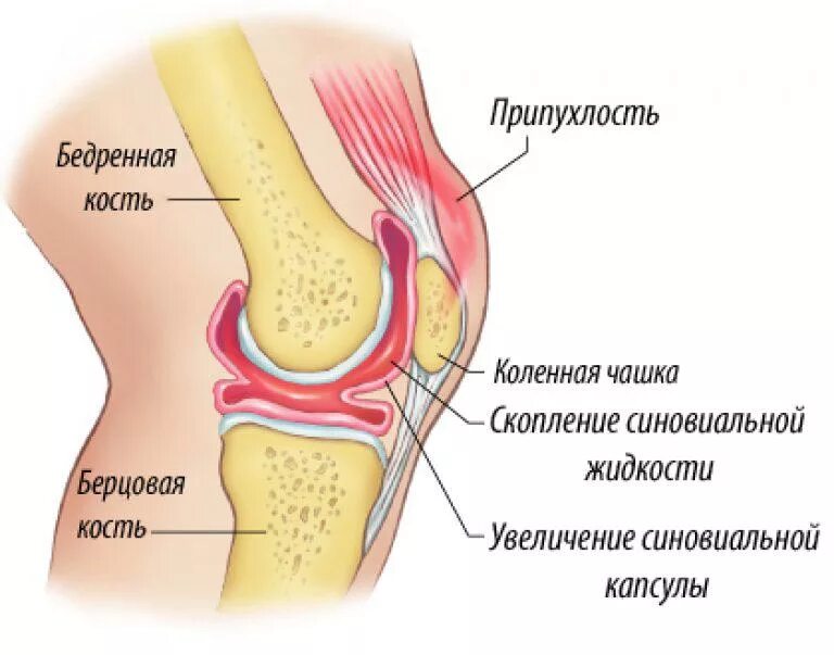 Синовит коленного сустава травма. Синовит колена коленного сустава. Периартрит коленного сустава. Супрапателлярный выпот.