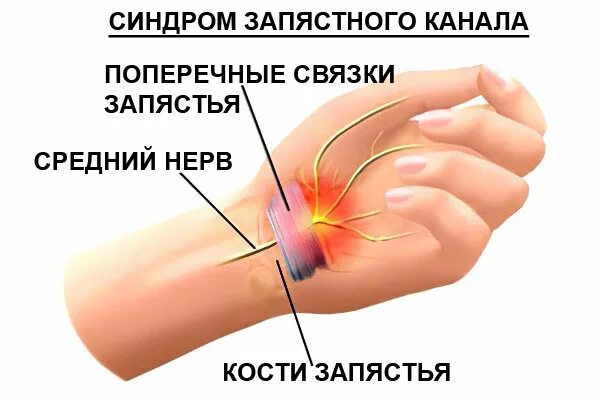 Синдром карпального канала запястья. Кистевой туннельный синдром. Туннельный синдром карпального канала. Туннельный синдром лучезапястного сустава. После операции запястного канала