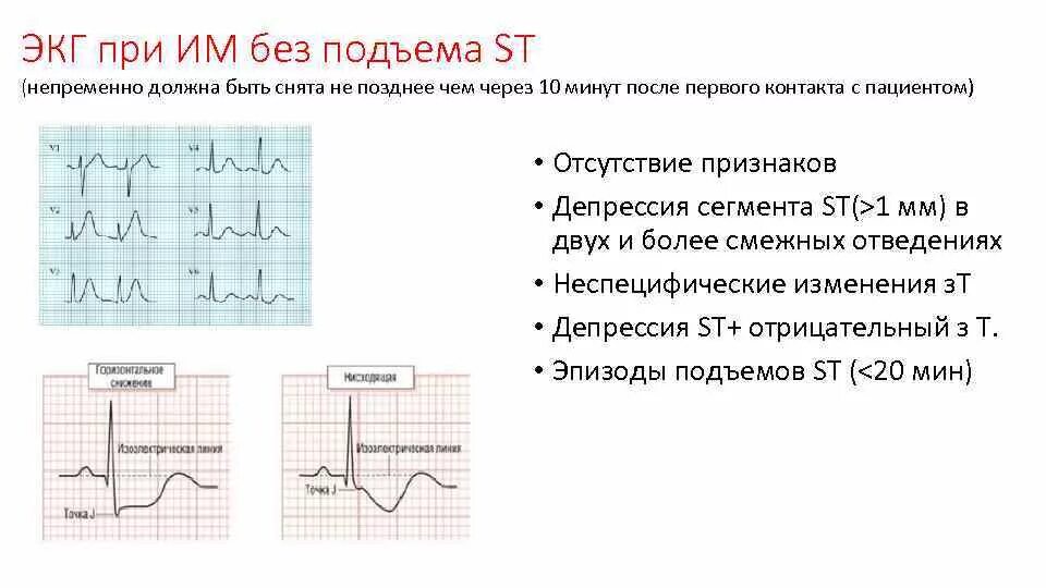 Без подъема st на экг. ЭКГ Окс без подъема сегмента St. Острый коронарный синдром без подъема сегмента St ЭКГ. Окс без подъема сегмента St ЭКГ признаки. ЭКГ при инфаркте миокарда без подъема St.