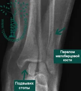Головка берцовой кости перелом