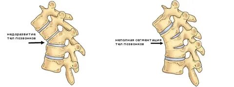 У ребенка клиновидный позвонок