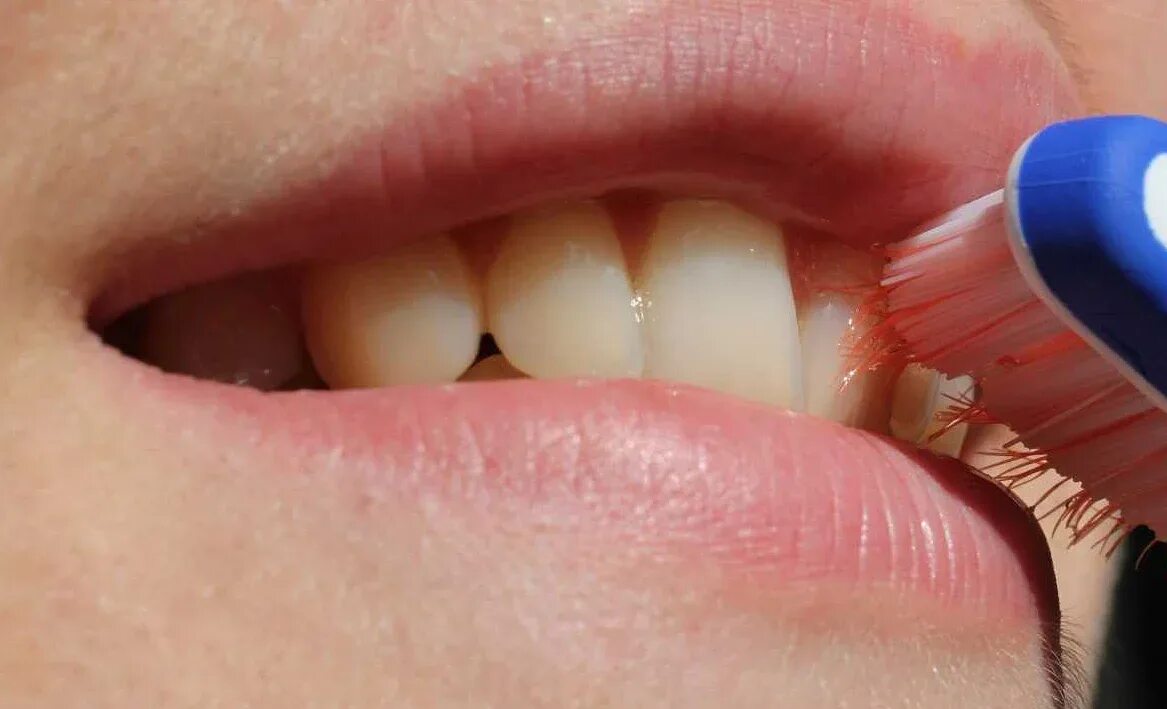Воспаление и кровоточивость десен. Кровоточивость десен при чистке зубов.