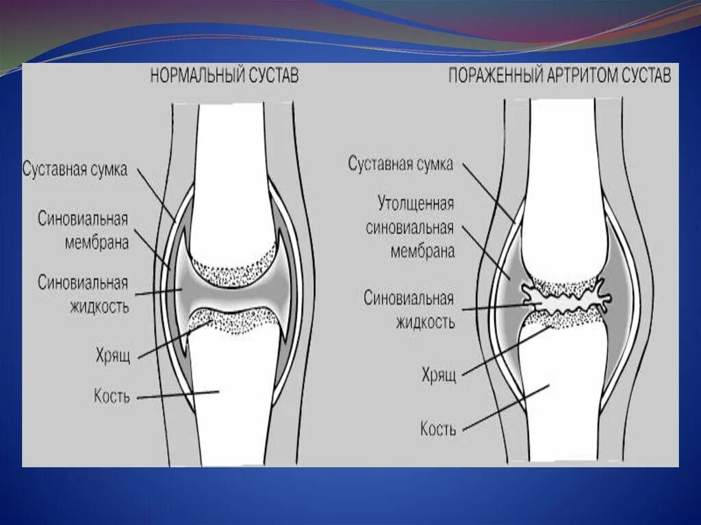 Синовиальная жидкость и суставная жидкость. Суставная синовиальная жидкость коленного сустава. Синовиальная сумка сустава.