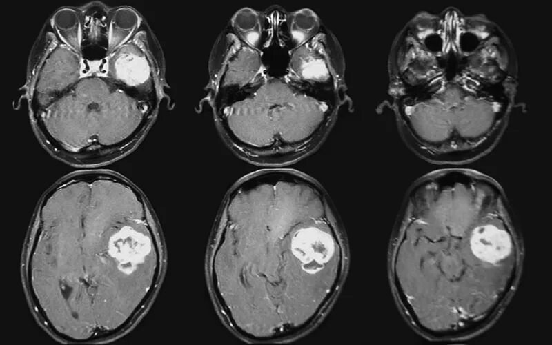 Мрт с контрастом головного. Глиома головного мозга кт. Опухоль головного мозга на кт с контрастом. Злокачественная опухоль головного мозга на кт. Кт мрт опухоли головного мозга.