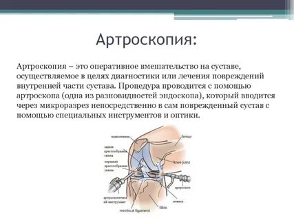 Внутренние повреждения внутреннего сустава
