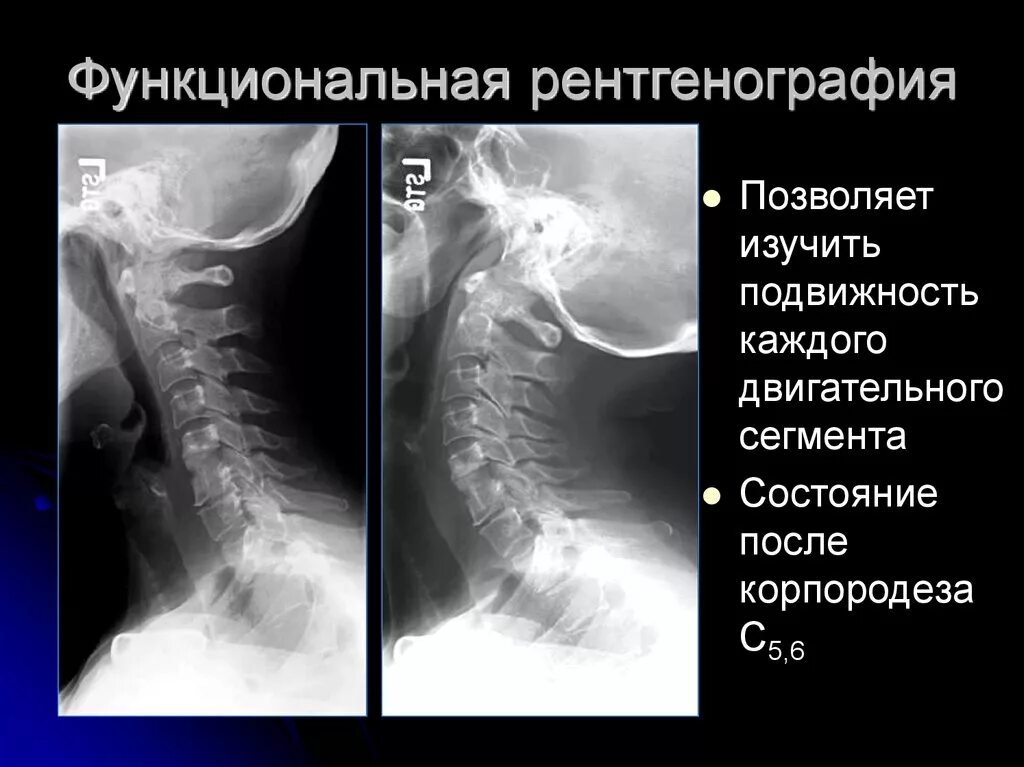 Рентгенография позвоночника в 2 х проекциях. Рентген шейного отдела позвоночника с функциональными пробами. Шейный отдел позвоночника рентген с1-с2. Рентген поясничного отдела с функциональными пробами. Функциональные пробы поясничного отдела позвоночника рентген.