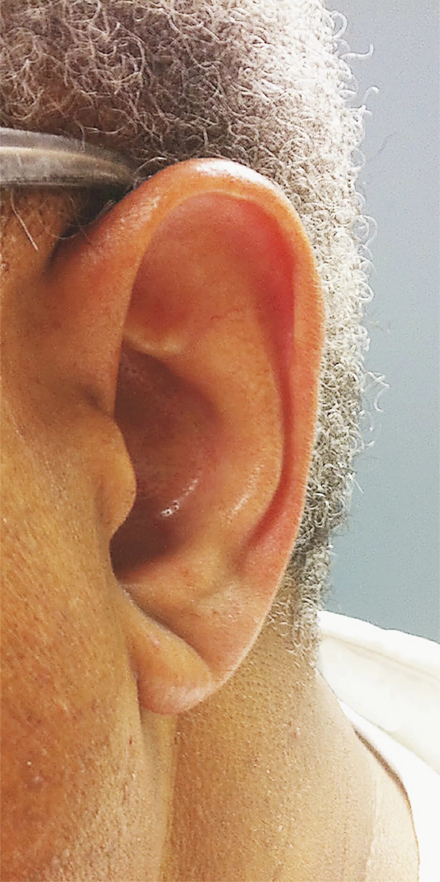 Диагональная складка на мочке уха.