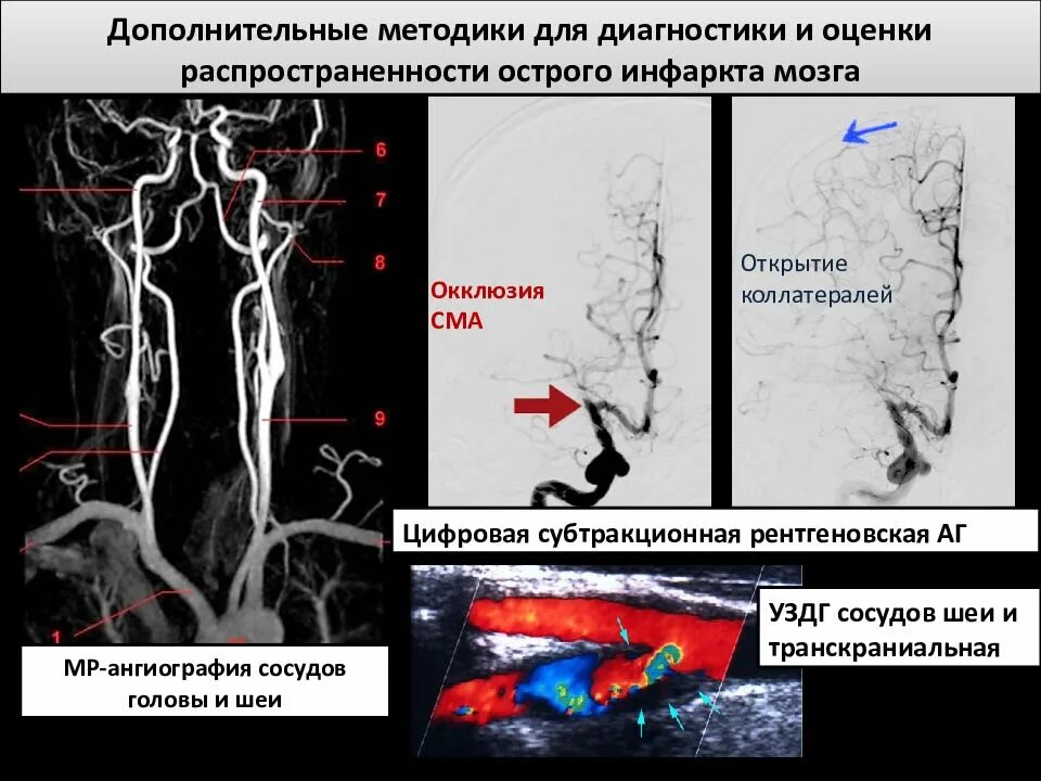Окклюзия средней мозговой артерии. Окклюзия магистральных артерий. Инфаркт средней мозговой артерии. Окклюзия базилярной артерии. Тромбоз артерий мозга