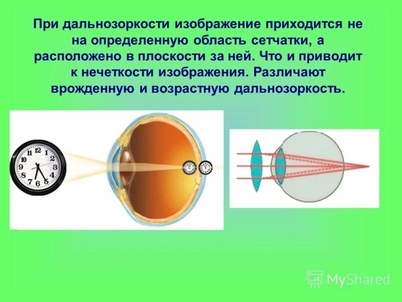 Зрение дефекты зрения. Дальнозоркость за сетчаткой. Дальнозоркость книги. Дальнозоркость за сетчаткой. Зрение дальнозоркость это плюс или минус.
