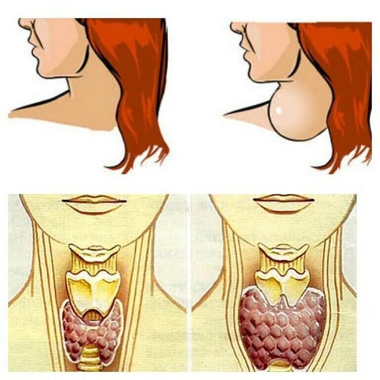 Увеличился узел щитовидной железы. Тиреоидный узел щитовидной железы что это такое-. Узлы ВЩ итов дной железе.