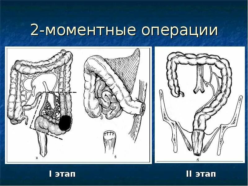 Опущение поперечно-ободочной кишки. Опущение поперечной ободочной кишки. Патологии ободочной кишки. Птоз поперечно ободочной кишки. Симптомы операция кишечнике