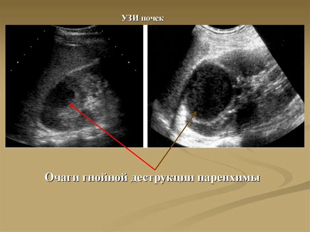 УЗИ почек острый пиелонефрит. Хронический пиелонефрит УЗИ. УЗИ почек хронический пиелонефрит. УЗИ критерии хронического пиелонефрита. Узи почка не видна