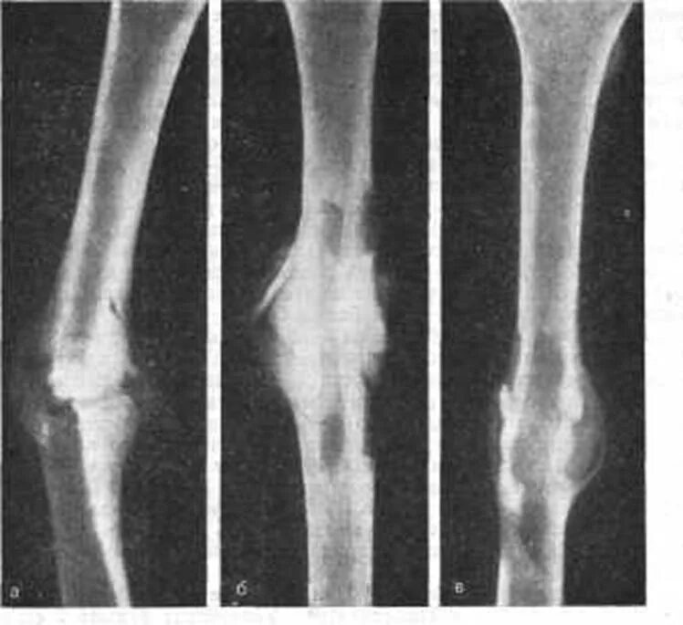 Костная мозоль при переломе.берцовой кости. Остеосклероз бедренной кости рентген. Костная мозоль после перелома большеберцовой кости на рентгене. Сросшийся перелом бедренной кости рентген.