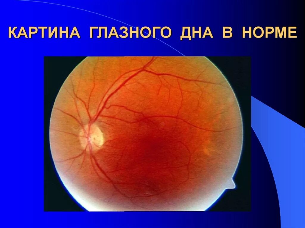 Болезнь глазного дна. Офтальмоскопия глазного дна норма. Нормальная картина глазного дна. Заболевания зрительного нерва.