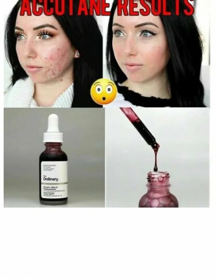 Ordinary кровавый пилинг. The ordinary / кислотный пилинг aha 30% + bha 2%. the ordinary кислотный пилинг для лица / кровавый пилинг aha 30%. the ordinary пилинг aha 30% + bha 2% 30 мл кровавый. кровавый пилинг ординари ординари.