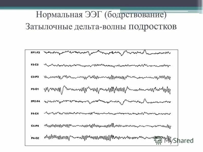 Нормальные ритмы на ЭЭГ. ЭЭГ головного мозга показатели. Энцефалограмма головы нормальные показатели. ЭЭГ волны норма.