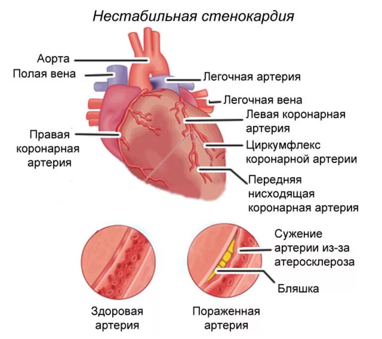 Сердечная недостаточность при инфаркте миокарда. Нестабильная стенокардия. Не стобильная стенокардия.