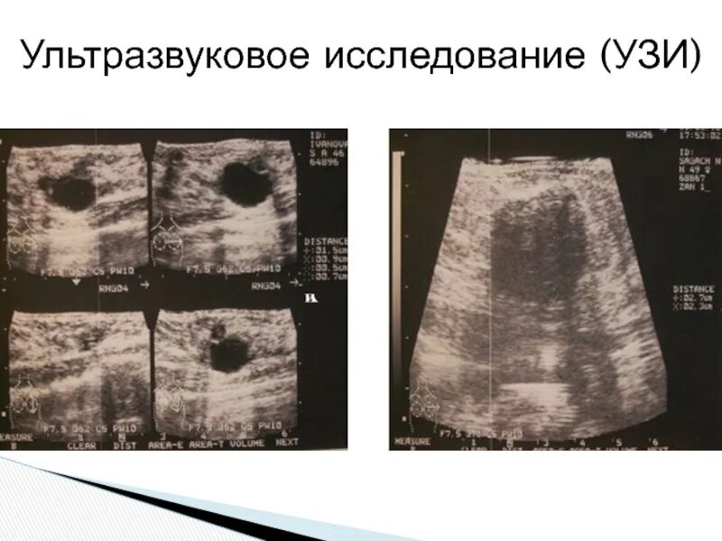 УЗИ снимки фиброаденомы молочной железы. Фиброаденома мол жел УЗИ. УЗИ молочных желез фиброаденома УЗИ. Фиброаденома молочной железы УЗИ снимок. Как отличить на узи