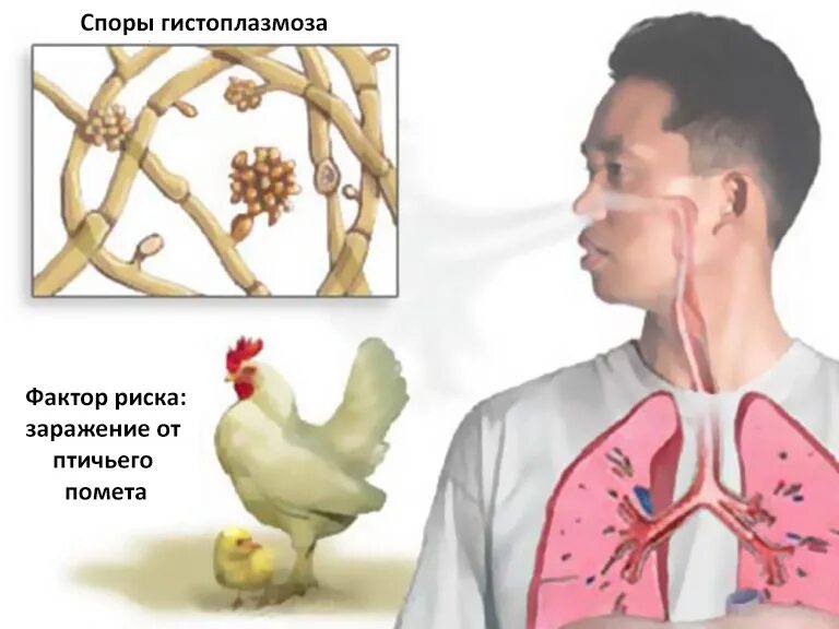 Гистоплазмоз это. Гистоплазмоз это