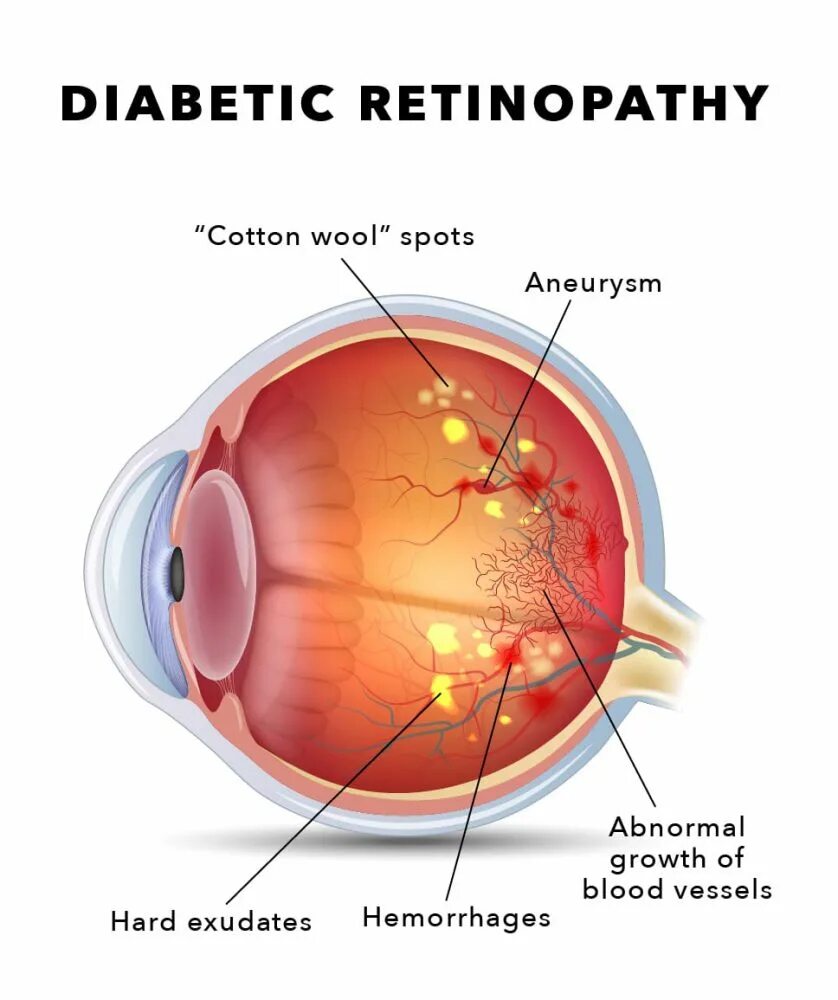 Гемофтальм мкб 10. Гемофтальм офтальмоскопия. Диабетическая микроангиопатия ретинопатия. Кровоизлияние в стекловидное тело (гемофтальм). Диабетическая ретинопатия глаз.
