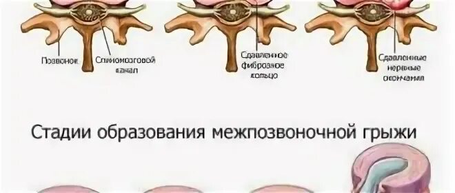 Стадии грыжи позвоночника. Грыжа позвоночника схема. Замена позвоночного диска. Межпозвоночная грыжа на УЗИ.