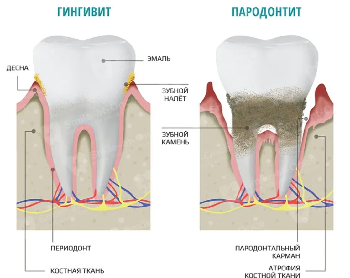 Воспаление зубов и десен.