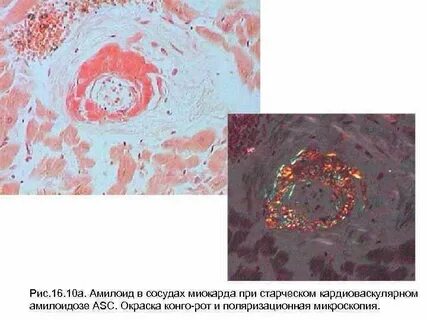 Амилоидоз миокарда