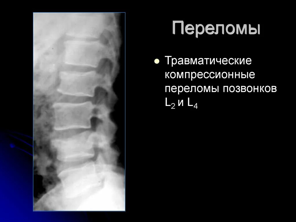 Компрессионный перелом позвоночника l1 l2. Компрессионный перелом позвоночника th11-l1. Компрессионный перелом l2 второй степени. Компрессионный перелом тела l1 позвонка. Компрессионный перелом тела 1 1