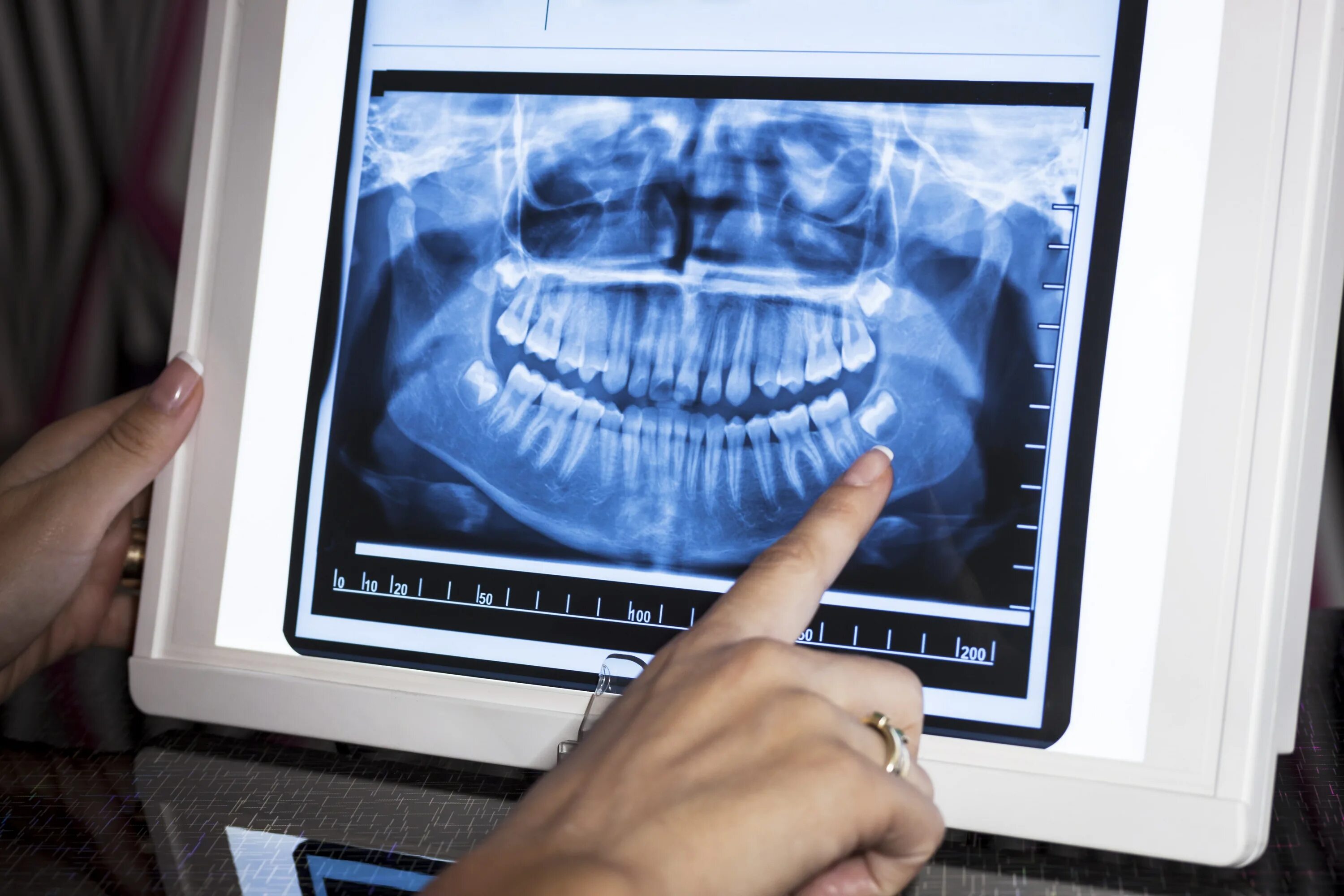 D a xray monolith. Ортопантомография (панорамная томография). Панорамная рентгенография зубов. Панорамные снимки зубов.