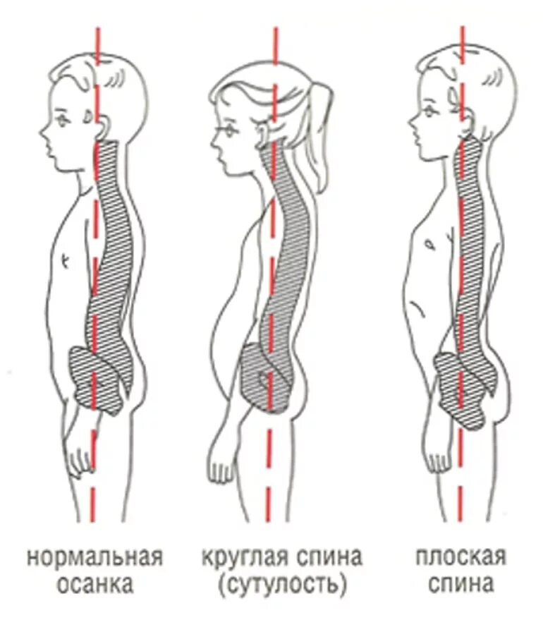 Нарушение изгиба позвоночника. Нарушение осанки круглая спина. Гиперлордоз и гиперкифоз. Лордоз поясничного отдела позвоночника гимнастика. Искривление позвоночника сутулость.