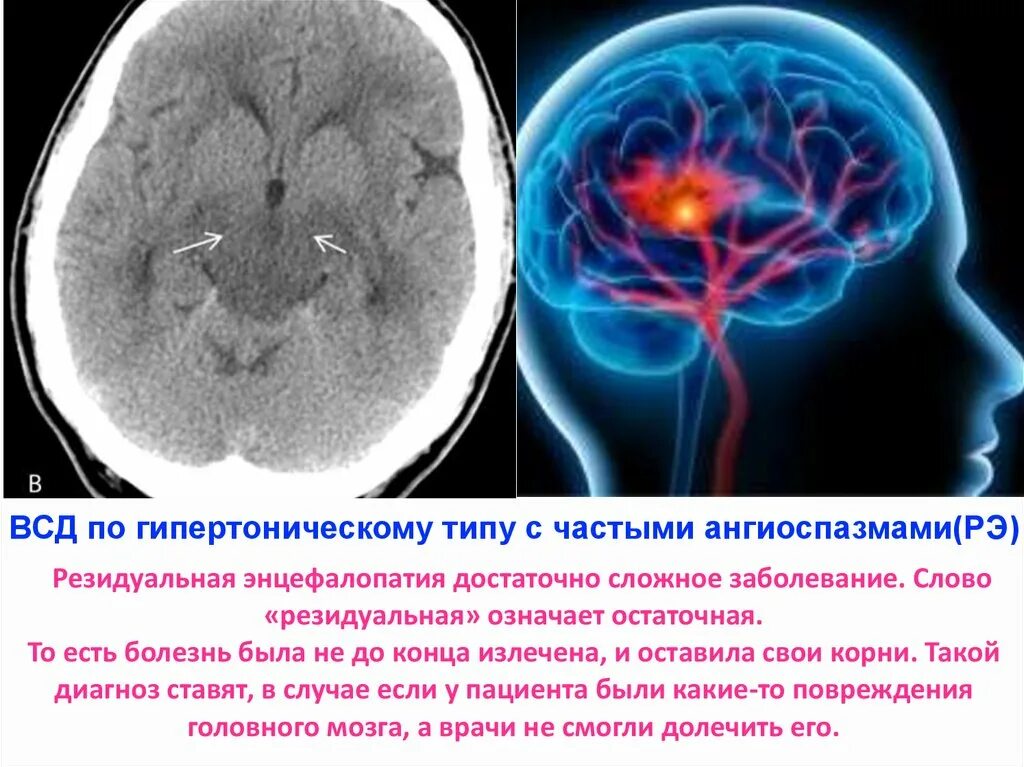 Резидуально органическое поражение головного. Энцефалопатия головного мозга что это такое. Резидуальная энцефалопатия. Симптомы резидуальной энцефалопатии. Вегето сосудистая дистония головного мозга.