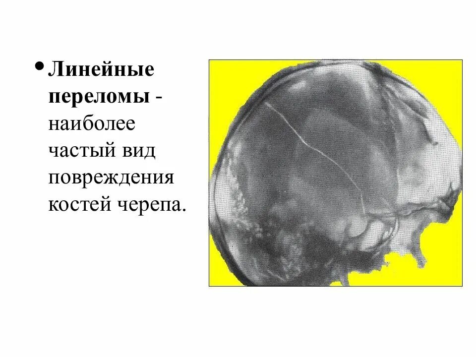 Переломы свода черепа классификация. Симптомы характерные для перелома основания черепа 4 правильных. Симптомы при переломе свода черепа. Чмт повреждения костей черепа. Черепно мозговая травма с переломом костей черепа.