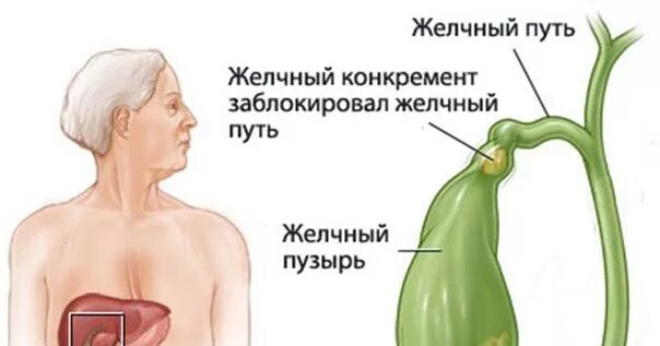 Симптомы плохой желчи. Стаз желчи в желчном пузыре. Застойный желчный пузырь. Застой в желчном пузыре причины. Накопление желчи в желчном пузыре.