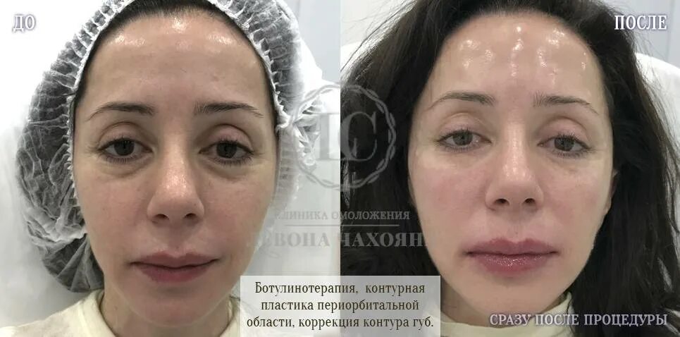 Рекомендации после ботулинотерапии
