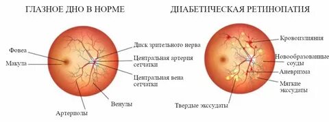 Фоновая ретинопатия что это у взрослых