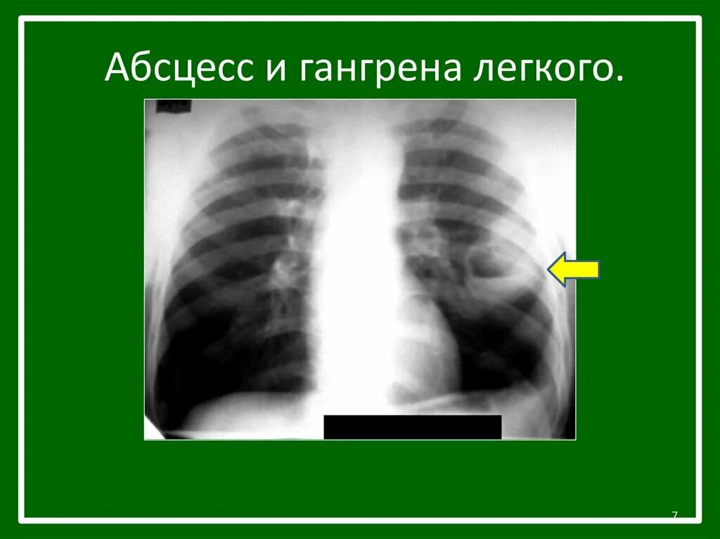 Абсцесс и гангрена легкого. Рентген при гангрене легких. Гангренозный абсцесс рентген. Гангренозный абсцесс легкого кт. Гангрена лёгких на рентгене.