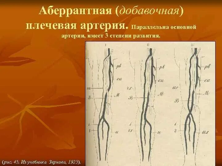 Аберрантная правая подключичная артерия кт. Аберрантная почечная артерия. Аберрантная плечевая артерия.