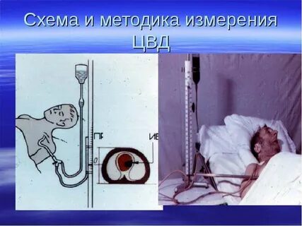 Укажите метод измерения венозного давления