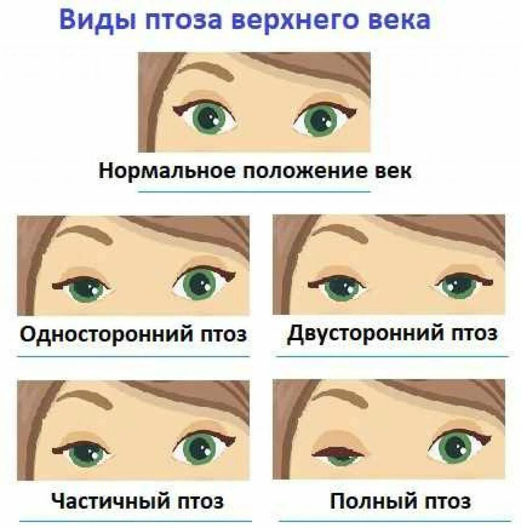 Птоз верхнего века 1 2 степени. Птоз 1 степени верхнего века. Птоз 2 степени глаза у ребенка.