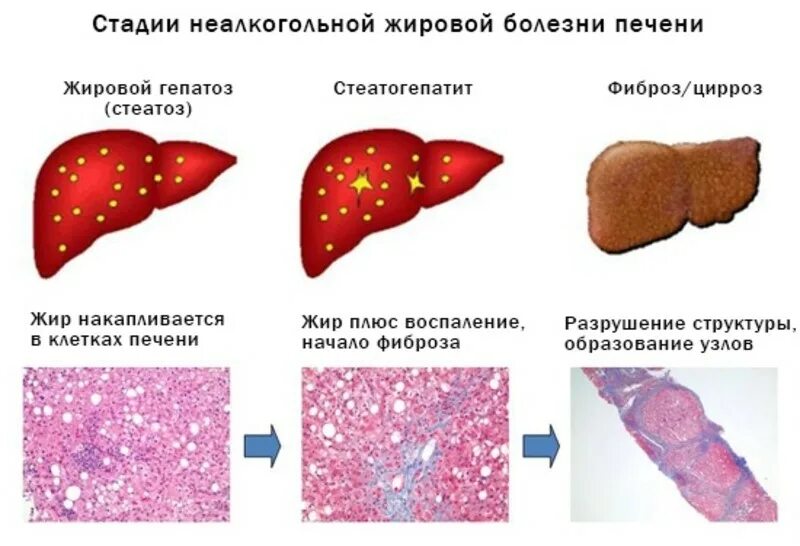 Неалкогольная жировая болезнь печени степени. Жировой гепатоз печени 2 степени. Стадии развития болезни печени.