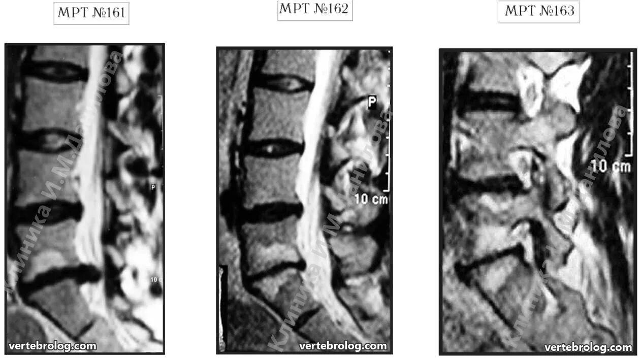 Мр картина дистрофических изменений поясничного отдела позвоночника. Секвестрированная грыжа l5-s1 мрт. Дегенеративно-дистрофические изменения позвоночника мрт. Дегенеративно-дистрофические изменения позвоночника на кт.