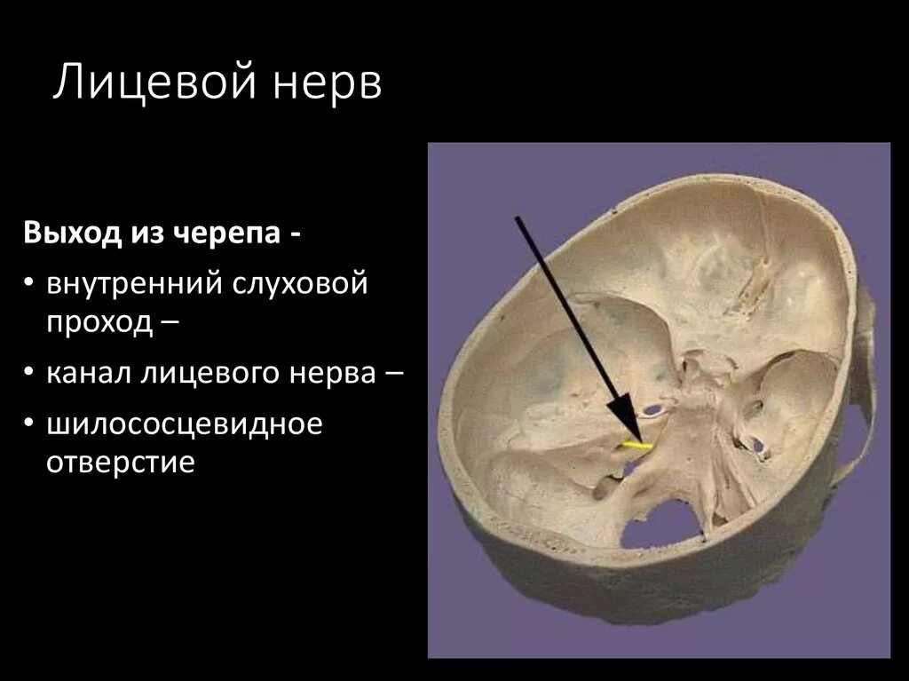 Выход лицевого нерва из черепа. Лицевой нерв во внутреннем слуховом проходе. Внутренний слуховой проход анатомия на череп. Лицевой нерв височная кость. Лицевой нерв череп