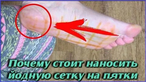 Зачем мажут йодом