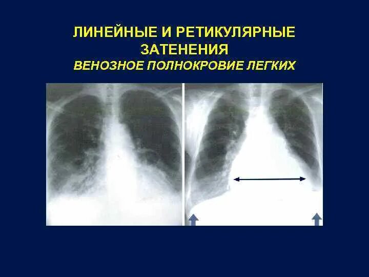 Венозный застой в легких рентген. Застой в легких рентген. Полнокровие легких на рентгене. Застойные легкие на рентгене. Застойные изменения в легких