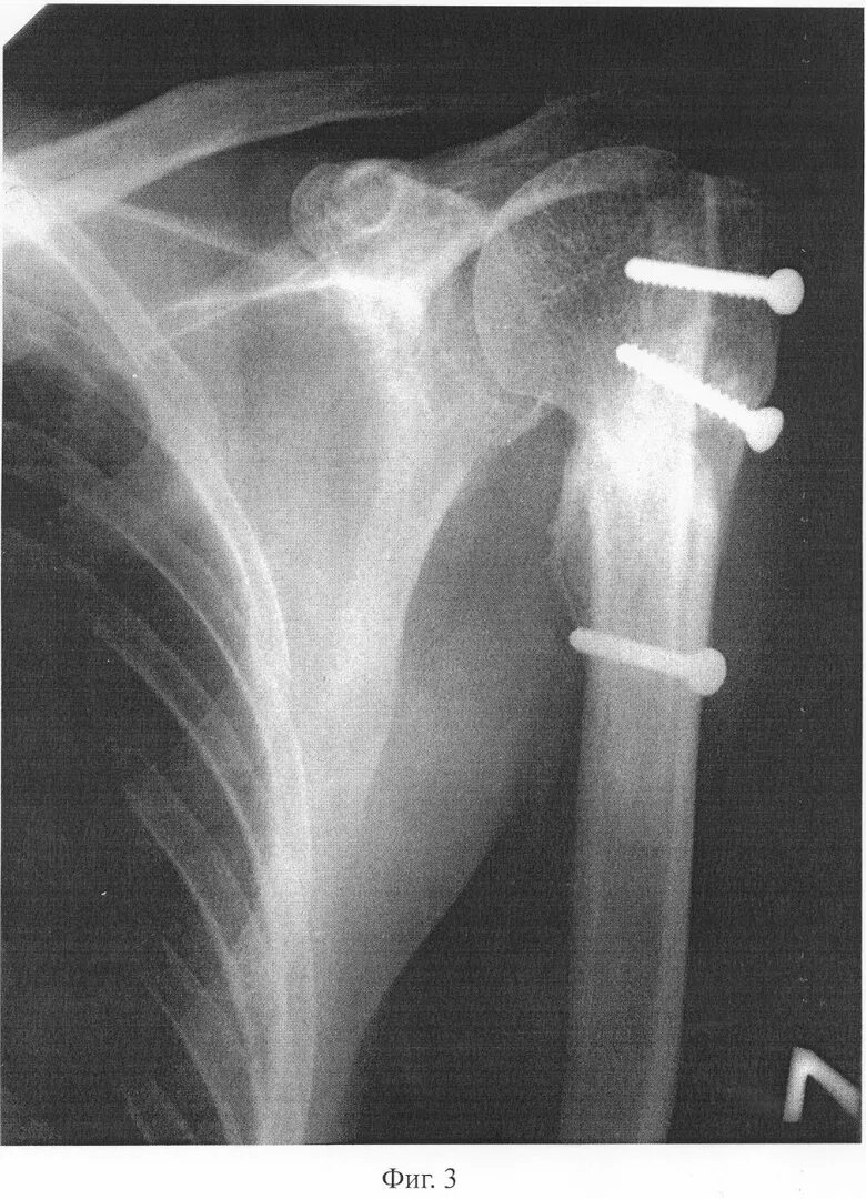 Перелом хирургической шейки плечевой кости рентген остеосинтез. Перелом шейки плеча операция рентген. Остеосинтез перелома плечевой кости. Остеосинтез шейки плеча рентген. Перелом плеча пластина