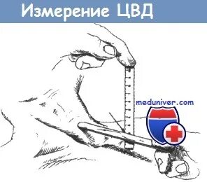Укажите метод измерения венозного давления